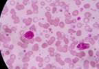 New Sickle Cell Disease Treatment Gets FDA Approval New Sickle Cell Disease Treatment Gets FDA Approval
