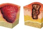 Pressure Area Pain Predicts Development of Pressure Ulcers Pressure Area Pain Predicts Development of Pressure Ulcers
