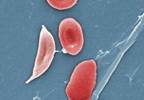 Diagnostic Criteria for Chronic Sickle Cell Disease-Related Pain Diagnostic Criteria for Chronic Sickle Cell Disease-Related Pain