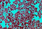Reducing Hospital-Acquired Infections Reducing Hospital-Acquired Infections