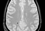 Accounting for Gender Differences in Concussion Diagnosis and Treatment Accounting for Gender Differences in Concussion Diagnosis and Treatment