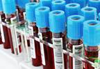 Biomarkers to Predict Dose Reductions, Discontinuation of Rheumatoid Arthritis Treatment? Biomarkers to Predict Dose Reductions, Discontinuation of Rheumatoid Arthritis Treatment?