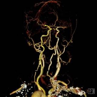 The study sought to determine whether children presenting with arteriopathy-related strokes were more likely to experience headaches at stroke onset. The study sought to determine whether children presenting with arteriopathy-related strokes were more likely to experience headaches at stroke onset.