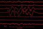 Management of Sleep Disorders-Related Headaches Management of Sleep Disorders-Related Headaches