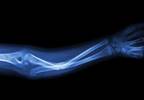 Fracture Healing not Accelerated by Ultrasound Fracture Healing not Accelerated by Ultrasound