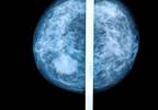 Optimal Management of Post-mastectomy Pain Syndrome Optimal Management of Post-mastectomy Pain Syndrome