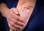 Psoriatic Arthritis Risk Increased by Depression Among Patients With Psoriasis Psoriatic Arthritis Risk Increased by Depression Among Patients With Psoriasis