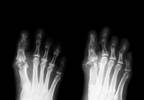 Diabetic Neuropathy: Updated Position Statement by the American Diabetes Association Diabetic Neuropathy: Updated Position Statement by the American Diabetes Association