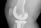 Joint Replacement Surgery Outcomes Improved With SSRIs Joint Replacement Surgery Outcomes Improved With SSRIs