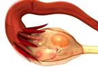 Female Reproductive Stages and Migraine Female Reproductive Stages and Migraine
