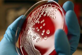 <i>S. aureus</i> infection can range in severity from uncomplicated skin infection to potentially lethal bacteremia. <i>Photo credit: Getty</i> <i>S. aureus</i> infection can range in severity from uncomplicated skin infection to potentially lethal bacteremia. <i>Photo credit: Getty</i>