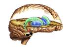 Dopamine Release Reduced During Acute Migraine Dopamine Release Reduced During Acute Migraine