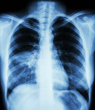 Patients who used benzodiazepines for 30 days or less were at greatest risk for pneumonia. Patients who used benzodiazepines for 30 days or less were at greatest risk for pneumonia.