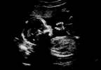 Migraine, Fetal Growth Restriction Associated in Men Migraine, Fetal Growth Restriction Associated in Men