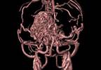 Arteriovenous Malformations-Related Headache Identification, Treatment Arteriovenous Malformations-Related Headache Identification, Treatment
