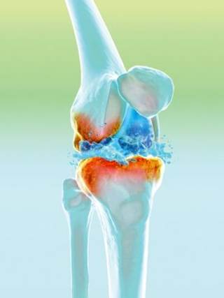 Both hyaluronan-based injections were found to be safe and effective for 6 months in patients with knee osteoarthritis. Both hyaluronan-based injections were found to be safe and effective for 6 months in patients with knee osteoarthritis.