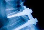Perioperative Lidocaine Offers No Benefits in Patients Undergoing Spinal Fusion Perioperative Lidocaine Offers No Benefits in Patients Undergoing Spinal Fusion