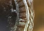 Certain Osteoporotic Drugs Effective in Preventing Secondary Vertebral Fractures Certain Osteoporotic Drugs Effective in Preventing Secondary Vertebral Fractures