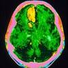 Minimum Headache Duration Requiring Subarachnoid Hemorrhage Evaluation Minimum Headache Duration Requiring Subarachnoid Hemorrhage Evaluation