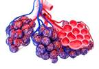 SLE Disease Flares Associated With Childhood Diffuse Alveolar Hemorrhage SLE Disease Flares Associated With Childhood Diffuse Alveolar Hemorrhage