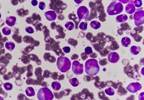 CAR T Cell Therapy for Acute Lymphoblastic Leukemia Recommended by FDA CAR T Cell Therapy for Acute Lymphoblastic Leukemia Recommended by FDA