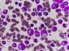 CAR T Cell Therapy for Acute Lymphoblastic Leukemia Recommended by FDA CAR T Cell Therapy for Acute Lymphoblastic Leukemia Recommended by FDA