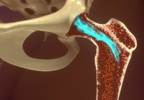 Stem Cell Therapy for Pain Management Stem Cell Therapy for Pain Management