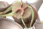 Low Back Pain Relieved with Dorsal Root Ganglion Stimulation Low Back Pain Relieved with Dorsal Root Ganglion Stimulation