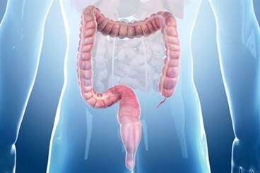 Higher CRC Risk With Advanced Adenoma Found on Colonoscopy Higher CRC Risk With Advanced Adenoma Found on Colonoscopy