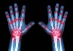 Juvenile Idiopathic Arthritis: Risk Factors for Infection of Biologic Therapy Juvenile Idiopathic Arthritis: Risk Factors for Infection of Biologic Therapy