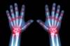 Juvenile Idiopathic Arthritis: Risk Factors for Infection of Biologic Therapy Juvenile Idiopathic Arthritis: Risk Factors for Infection of Biologic Therapy