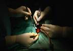 Patent Foramen Ovale Closure for Migraine: Weighing Risks and Benefits Patent Foramen Ovale Closure for Migraine: Weighing Risks and Benefits