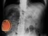 Spinal Cord Stimulation Reduces Pain in Diabetic Polyneuropathy Spinal Cord Stimulation Reduces Pain in Diabetic Polyneuropathy