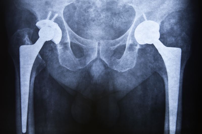 Sciatic Nerve Pain After Hip Replacement Surgery