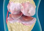 Cooled Radiofrequency Ablation Relieves Osteoarthritis-Related Knee Pain Cooled Radiofrequency Ablation Relieves Osteoarthritis-Related Knee Pain
