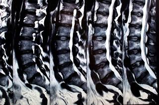 Percutaneous chemonucleolysis with radiopaque gelified ethanol may be safe and effective for patients with chronic radicular leg pain. Percutaneous chemonucleolysis with radiopaque gelified ethanol may be safe and effective for patients with chronic radicular leg pain.