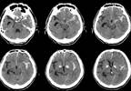 Subarachnoid Hemorrhage Linked to Key Clinical Characteristics of Headache Subarachnoid Hemorrhage Linked to Key Clinical Characteristics of Headache