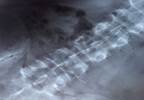 Milwaukee Brace for Adolescent Scoliosis Associated With Long-Term Back Pain Milwaukee Brace for Adolescent Scoliosis Associated With Long-Term Back Pain