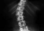 USPSTF Updates Recommendations on Screening for Adolescent Idiopathic Scoliosis USPSTF Updates Recommendations on Screening for Adolescent Idiopathic Scoliosis