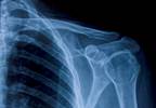 Reverse Total Shoulder Arthroplasty: Long-Term Clinical, Subjective Outcomes Reverse Total Shoulder Arthroplasty: Long-Term Clinical, Subjective Outcomes