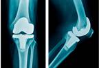 Updated Criteria for CRPS Diagnosis May Reveal Presence of Neuropathic Pain After TKA Updated Criteria for CRPS Diagnosis May Reveal Presence of Neuropathic Pain After TKA