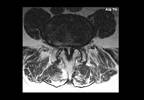 Transforaminal Epidural Steroid Injections Effective for Pain Relief in Lumbar Foraminal Spinal Stenosis Transforaminal Epidural Steroid Injections Effective for Pain Relief in Lumbar Foraminal Spinal Stenosis