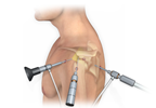 Examining the Additive Benefits of Stellate Ganglion Block for Shoulder Arthroscopy Examining the Additive Benefits of Stellate Ganglion Block for Shoulder Arthroscopy