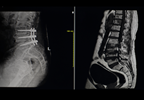 Reducing Opioid Consumption After Scoliosis Surgery in Adolescents Reducing Opioid Consumption After Scoliosis Surgery in Adolescents