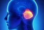 Cerebellar Hypoperfusion, Crossed Cerebellar Diaschisis in Migraine With Aura Cerebellar Hypoperfusion, Crossed Cerebellar Diaschisis in Migraine With Aura