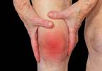 Knee Pain, Functional Impairment in Elderly Linked to Depressive Symptoms Knee Pain, Functional Impairment in Elderly Linked to Depressive Symptoms