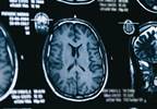 Persistent Posttraumatic Headache Associated With Reduced Cortical Thickness Persistent Posttraumatic Headache Associated With Reduced Cortical Thickness