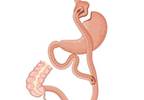 Bariatric Surgery Lessens Knee OA Pain More in Certain Patients Bariatric Surgery Lessens Knee OA Pain More in Certain Patients