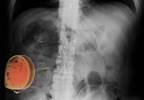 Standardized SCS Workflow May Effectively Alleviate Failed Back Surgery Syndrome-Related Pain Standardized SCS Workflow May Effectively Alleviate Failed Back Surgery Syndrome-Related Pain