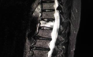 The acute pain resulting from vertebral fractures often develops into a chronic pain condition via peripheral and central sensitization processes. The acute pain resulting from vertebral fractures often develops into a chronic pain condition via peripheral and central sensitization processes.